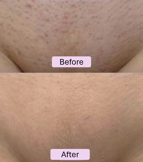 Crystal Hair Remover