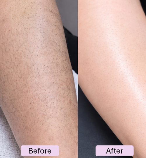 Crystal Hair Remover