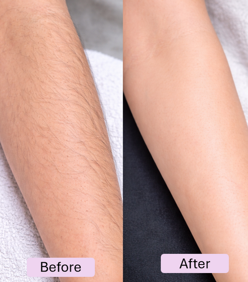 Crystal Hair Remover